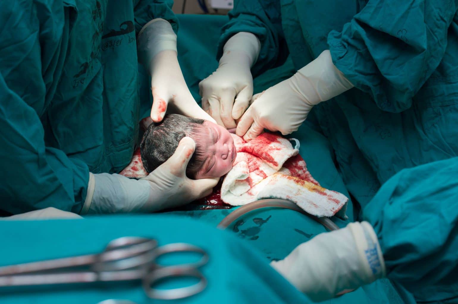הוצאת התינוק בניתוח קיסרי