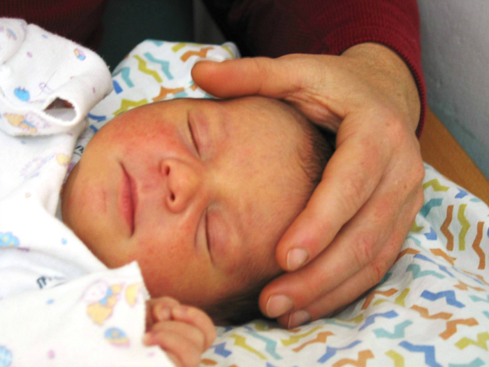 קרניוסקרל לתינוק שנולד בניתוח קיסרי
