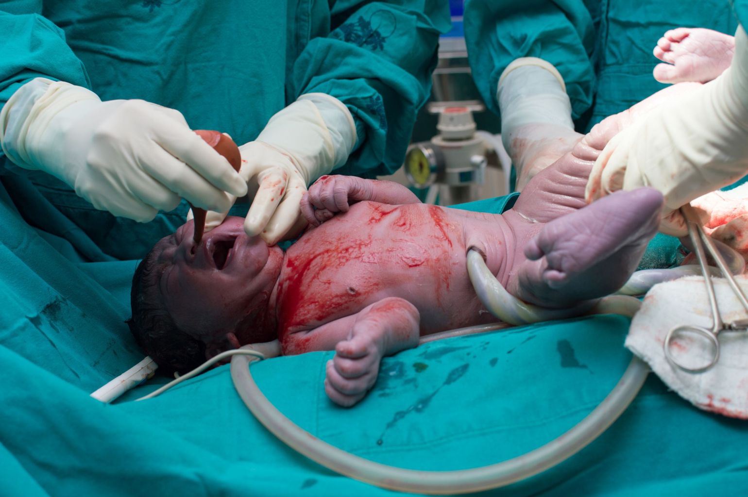 תינוק נולד בניתוח קיסרי