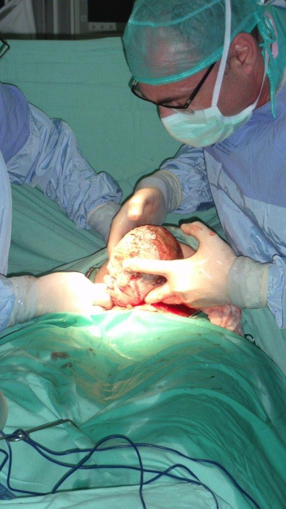 עשר עובדות על הידבקויות לאחר ניתוח קיסרי