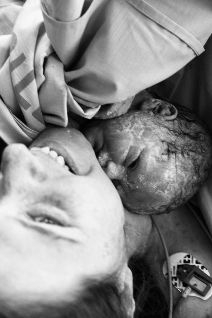 התינוק לאחר ניתוח קיסרי
