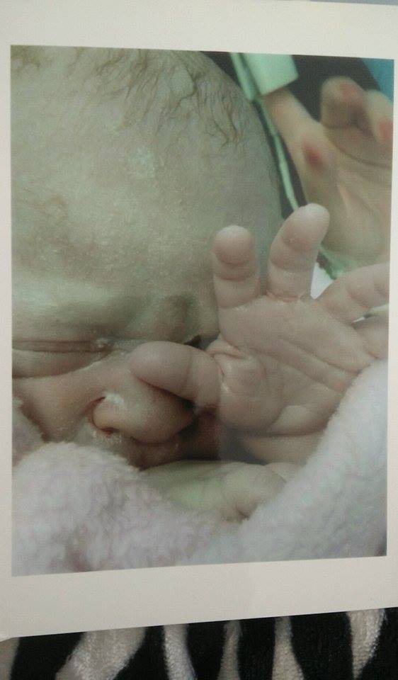 תינוק לאחר ניתוח קיסרי
